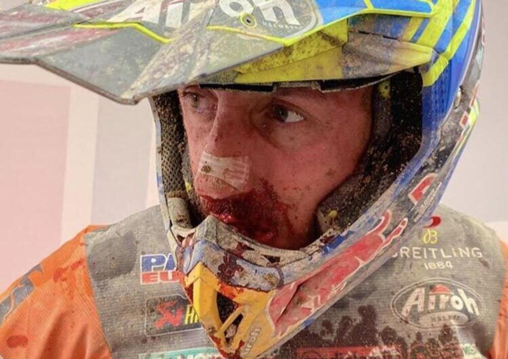 Tony Cairoli si rompe il naso ma non molla: ecco le immagini da vero campione