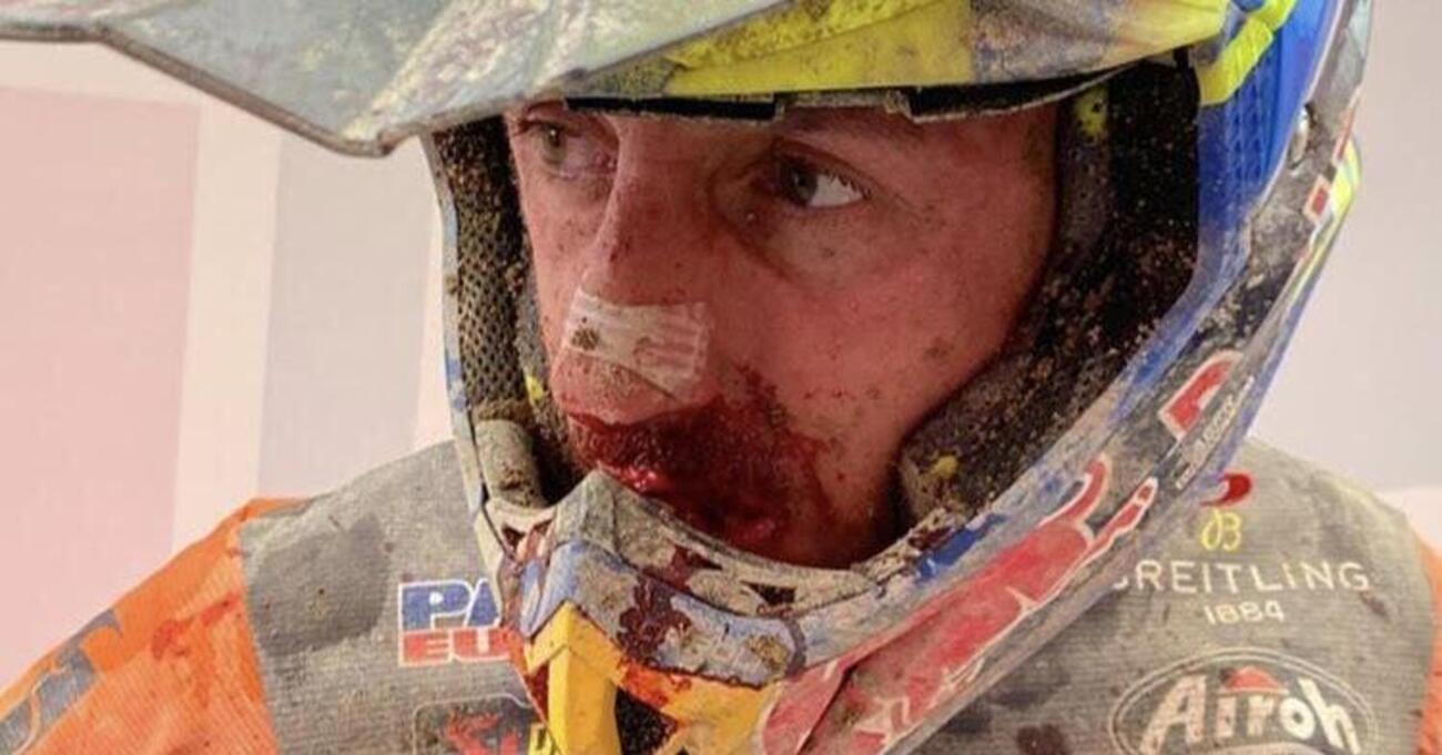 Tony Cairoli si rompe il naso ma non molla: ecco le immagini da vero campione