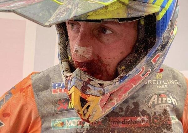 Tony Cairoli si rompe il naso ma non molla: ecco le immagini da vero campione