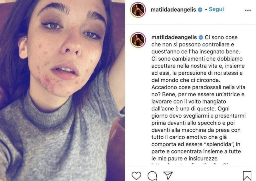 I brufoli di Matilda De Angelis sono la solita favola Disney &quot;naturale vs artefatto&rdquo;