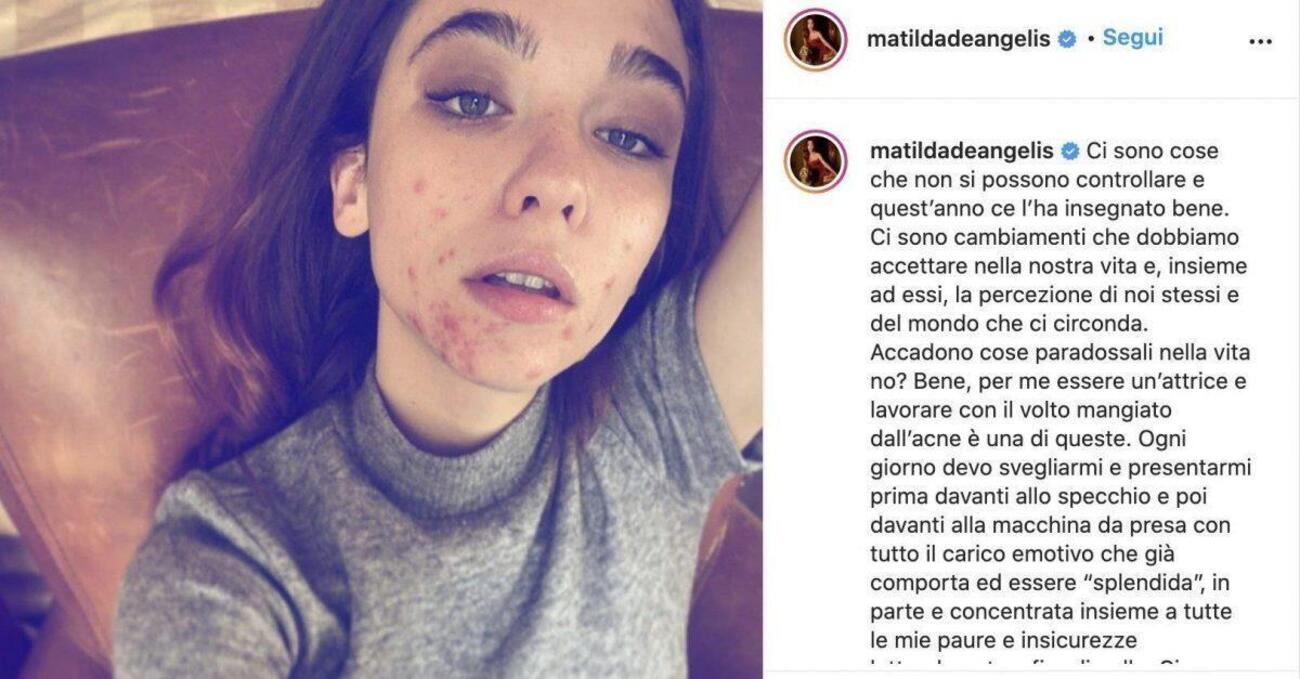 I brufoli di Matilda De Angelis sono la solita favola Disney &quot;naturale vs artefatto&rdquo;