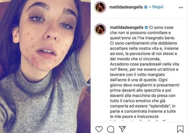 I brufoli di Matilda De Angelis sono la solita favola Disney &quot;naturale vs artefatto&rdquo;